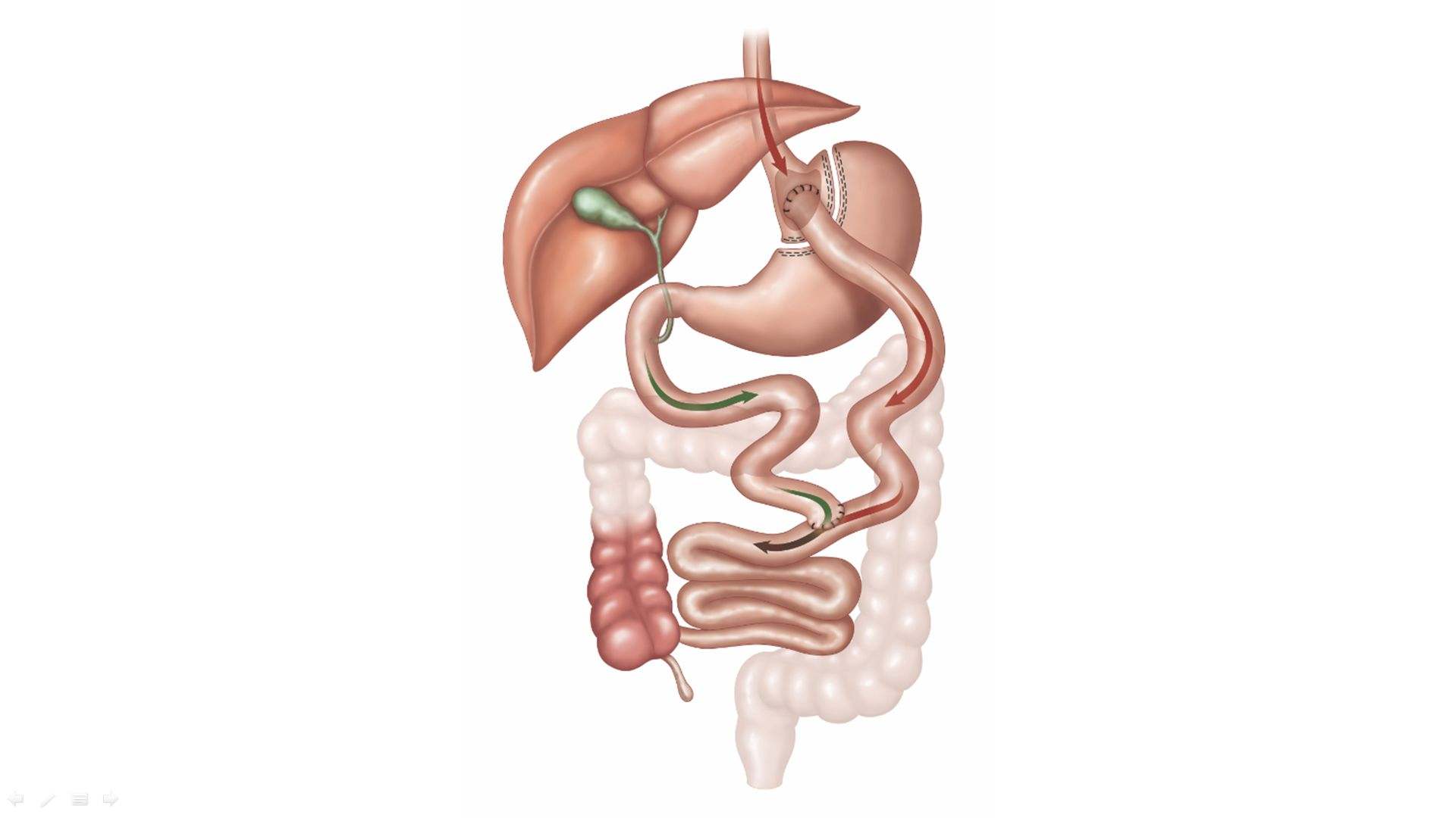 Gastric bypass - schemat